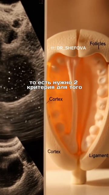 Поликистоз яичников главные мифы