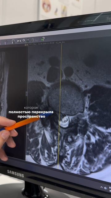 Болит низ спины, и отдает в ногу: что у вас на МРТ?