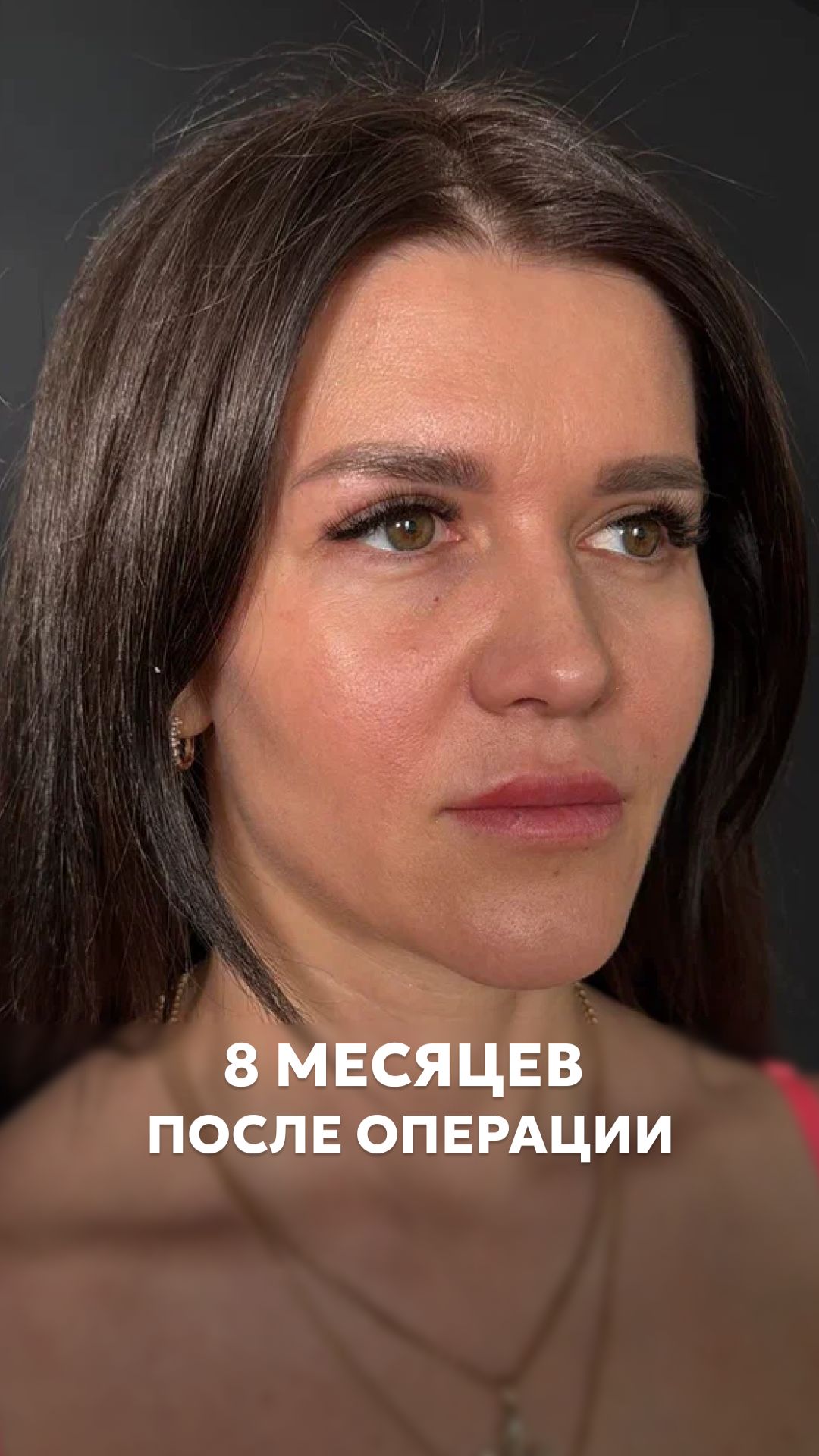 Верхняя блефаропластика. До и 8 месяцев после операции.