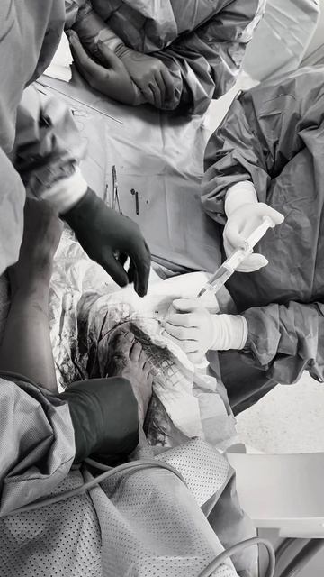 💉Проводниковая анестезия во время операции на Hallux Valgus: что чувствует и слышит пациент?