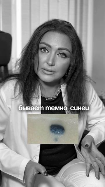 Опасные родинки