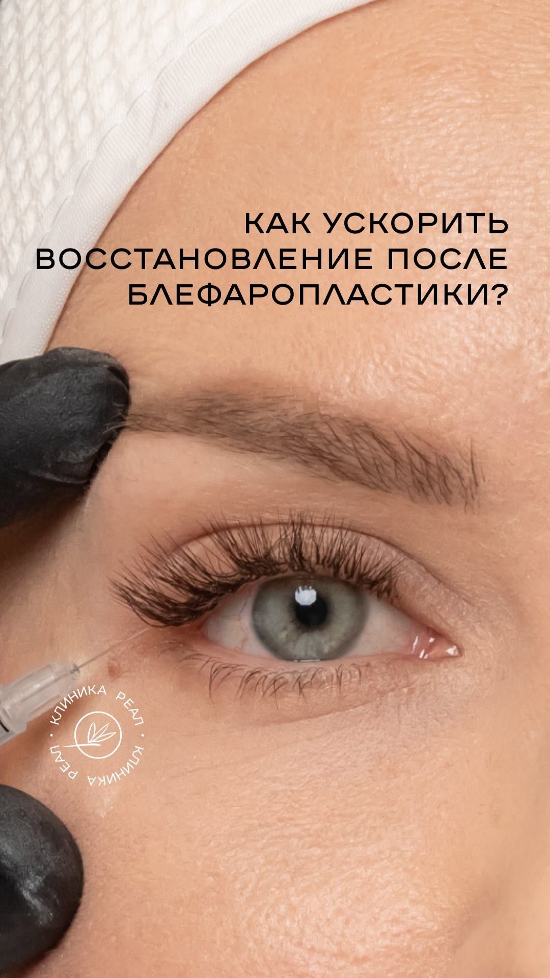 Блефаропластика — это не финальная точка, а начало восстановления.