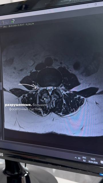Что будет со спиной, если не заниматься спортом?