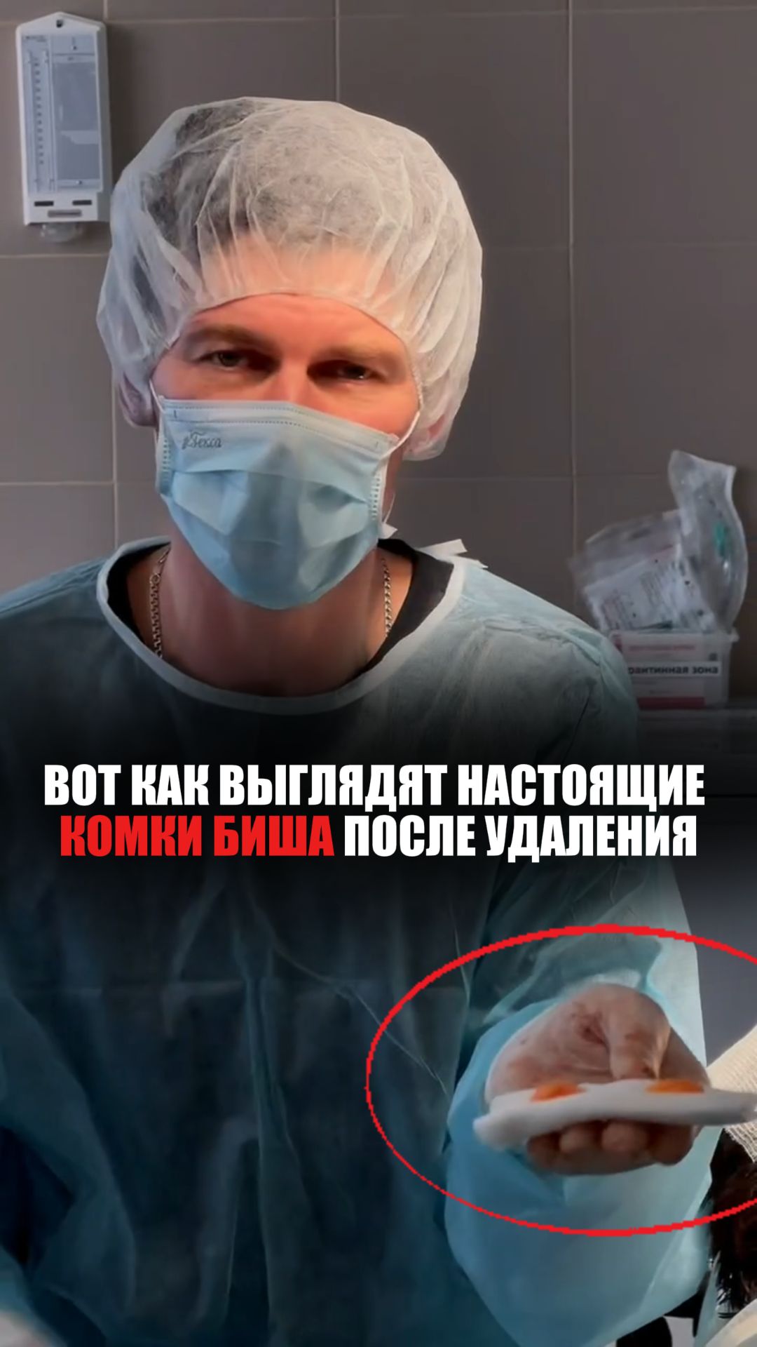ВОТ КАК ВЫГЛЯДЯТ НАСТОЯЩИЕ КОМКИ БИША ПОСЛЕ УДАЛЕНИЯ