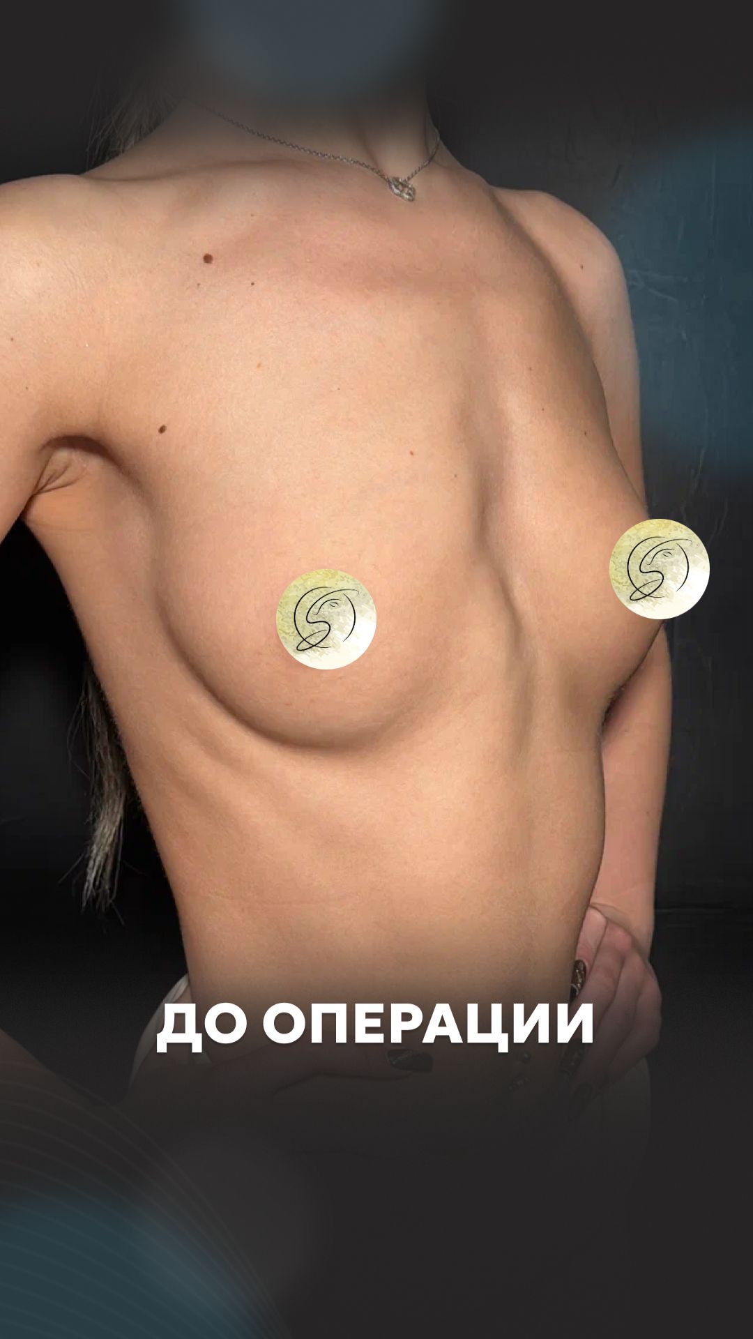 Увеличение груди. До операции