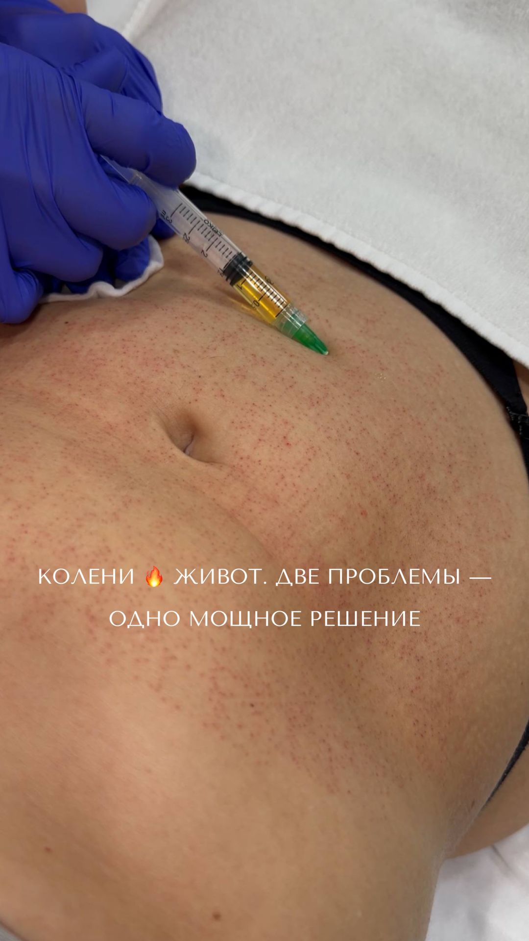 КОЛЕНИ 🔥 ЖИВОТ. Две проблемы — одно мощное решение. Никакой хирургии.