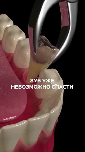 Жесткая правда о лечении от стоматолога-хирурга🦷⬆️