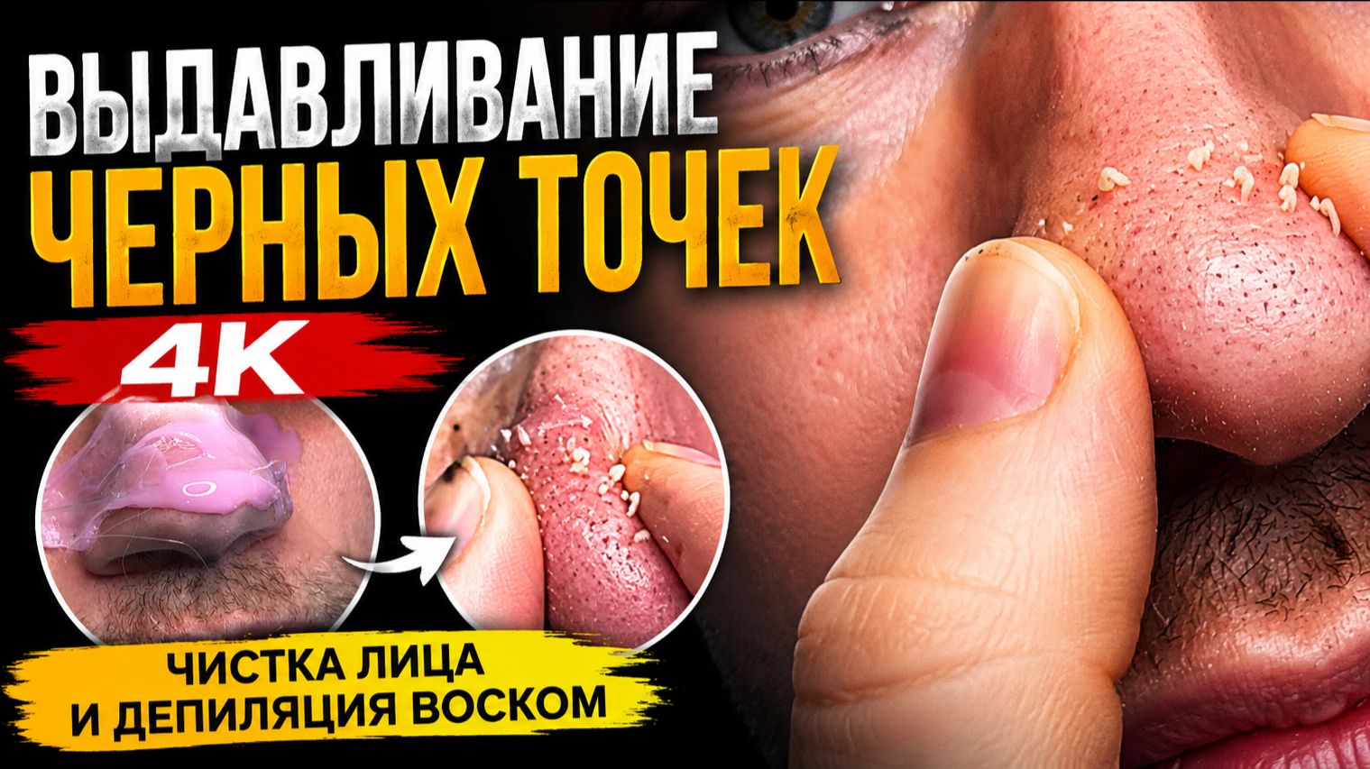 ✅ Выдавливание черных точек новое 2026  | Чистка лица и депиляция волос воском
