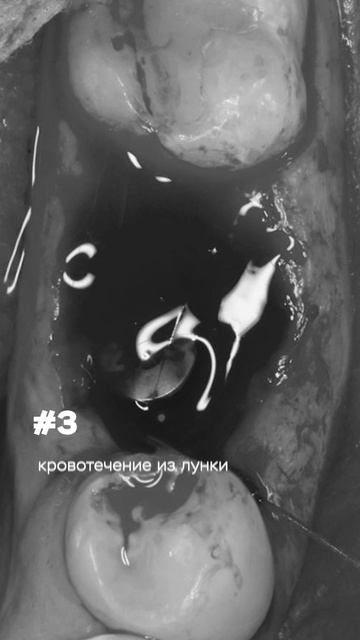 Что нельзя игнорировать после имплантации