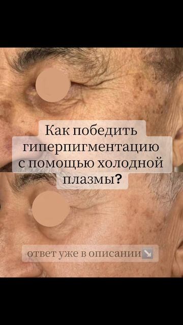 Как помогает холодная плазма Plazobest SUPERAN при борьбе с гиперпигментацией?