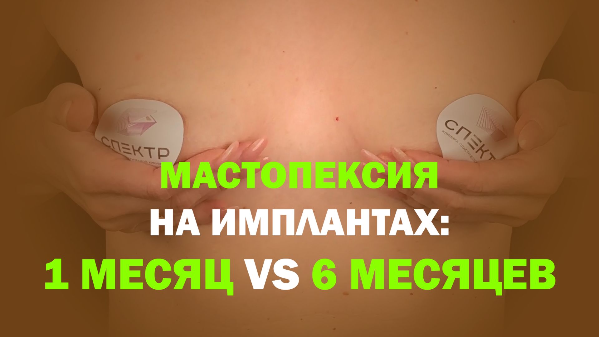Якорная мастопексия с имплантами: как меняется грудь в процессе восстановления