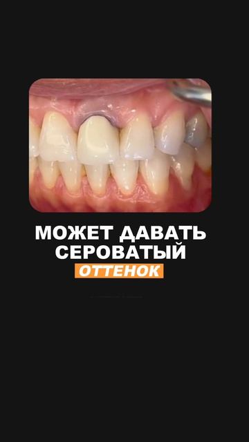 Виды коронок