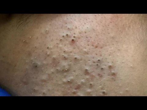 Корейский уход за кожей: от прыщей и чёрных точек
