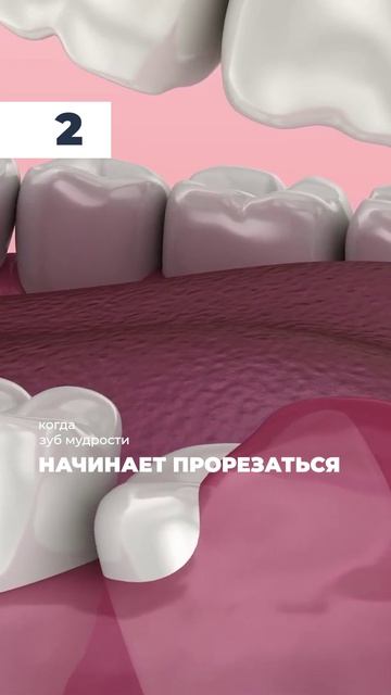 3 проблемы из-за зуба мудрости