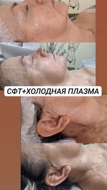 Потрясающие результаты До/После СФТ + холодная плазма