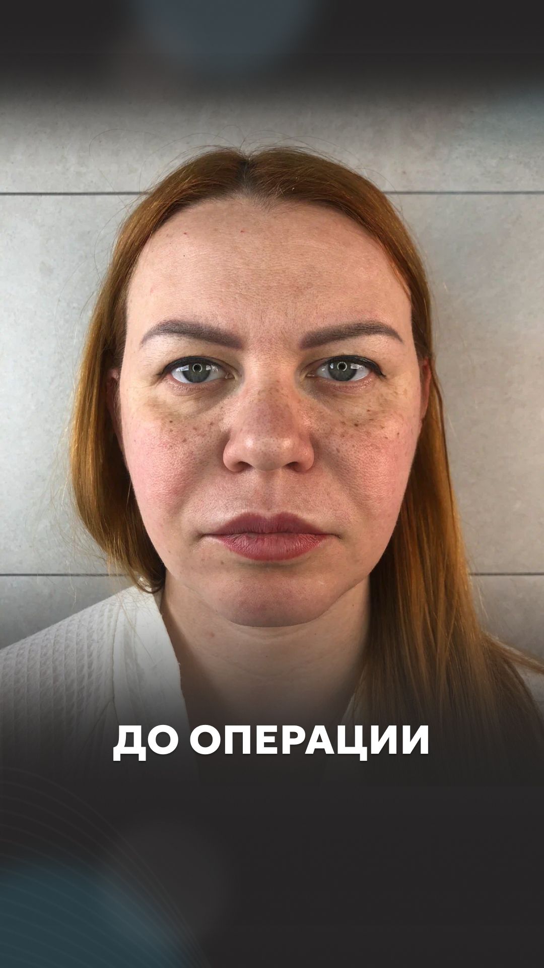 Элина. Блефаропластика
