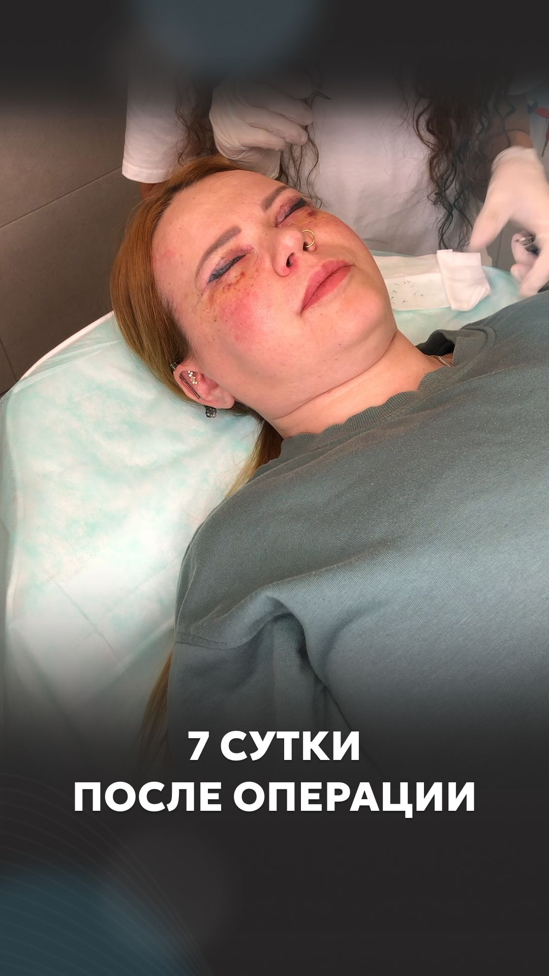 Снятие швов после круговой блефаропластики