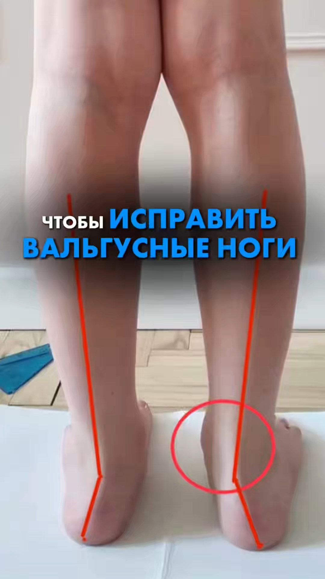 ЧТОБЫ ИСПРАВИТЬ ВАЛЬГУСНЫЕ НОГИ