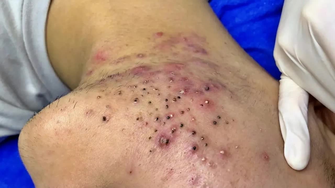 Удаление черных точек в Sac Dep Spa