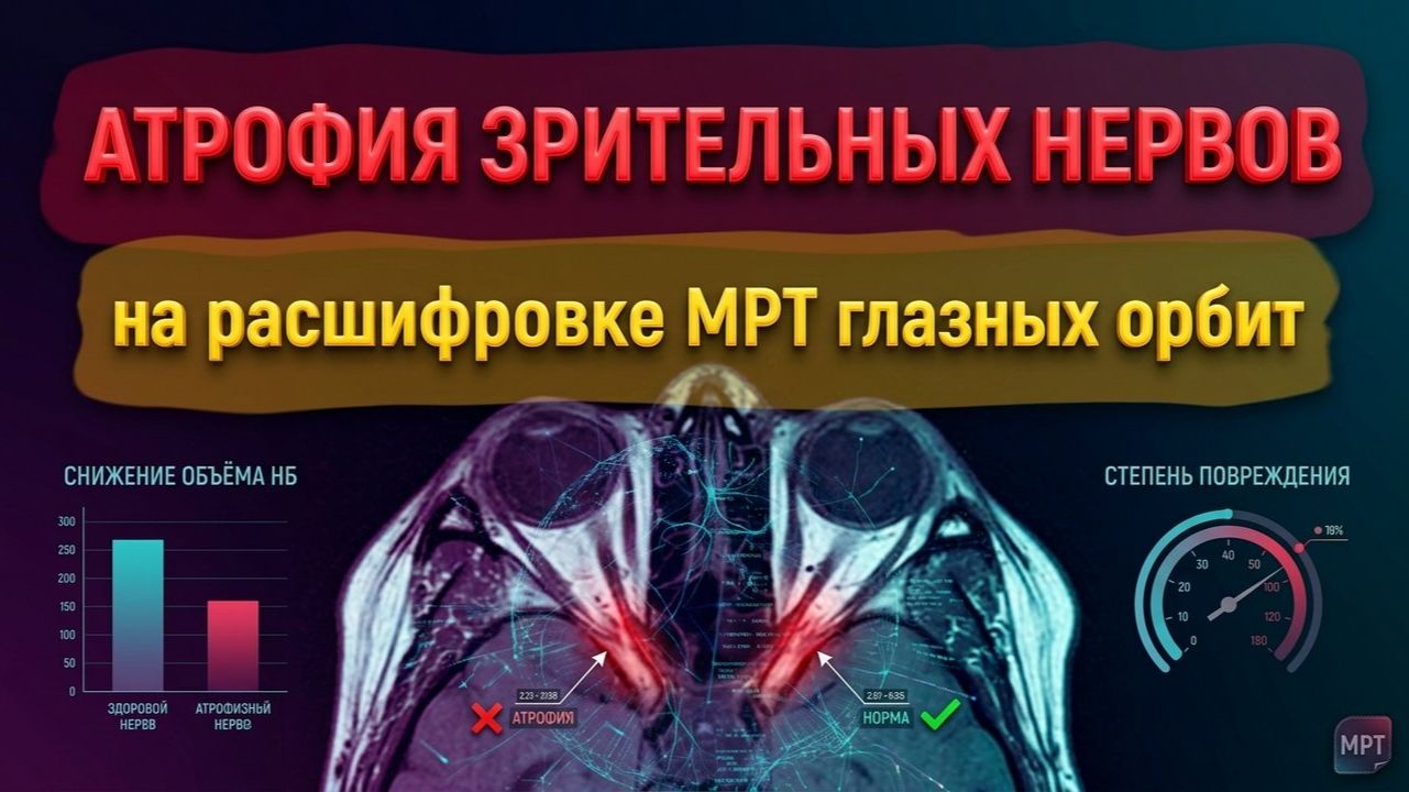 АТРОФИЯ зрительных нервов ЧАЗН обоих глаз и ВНУТРИЧЕРЕПНАЯ ГИПЕРТЕНЗИЯ на РАСШИФРОВКЕ МРТ орбит глаз