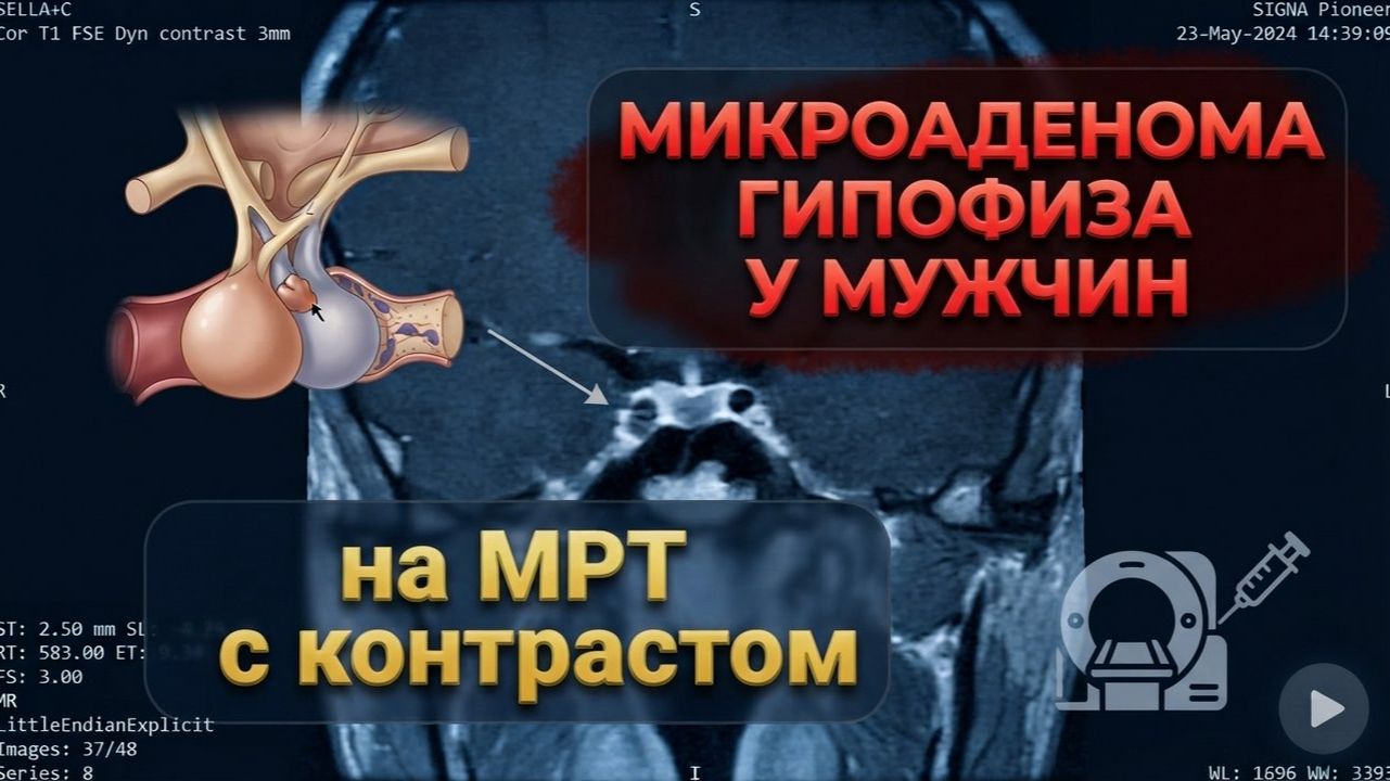 МИКРОАДЕНОМА гипофиза У МУЖЧИН на РАСШИФРОВКЕ (второе мнение) МРТ гипофиза с КОНТРАСТИРОВАНИЕМ