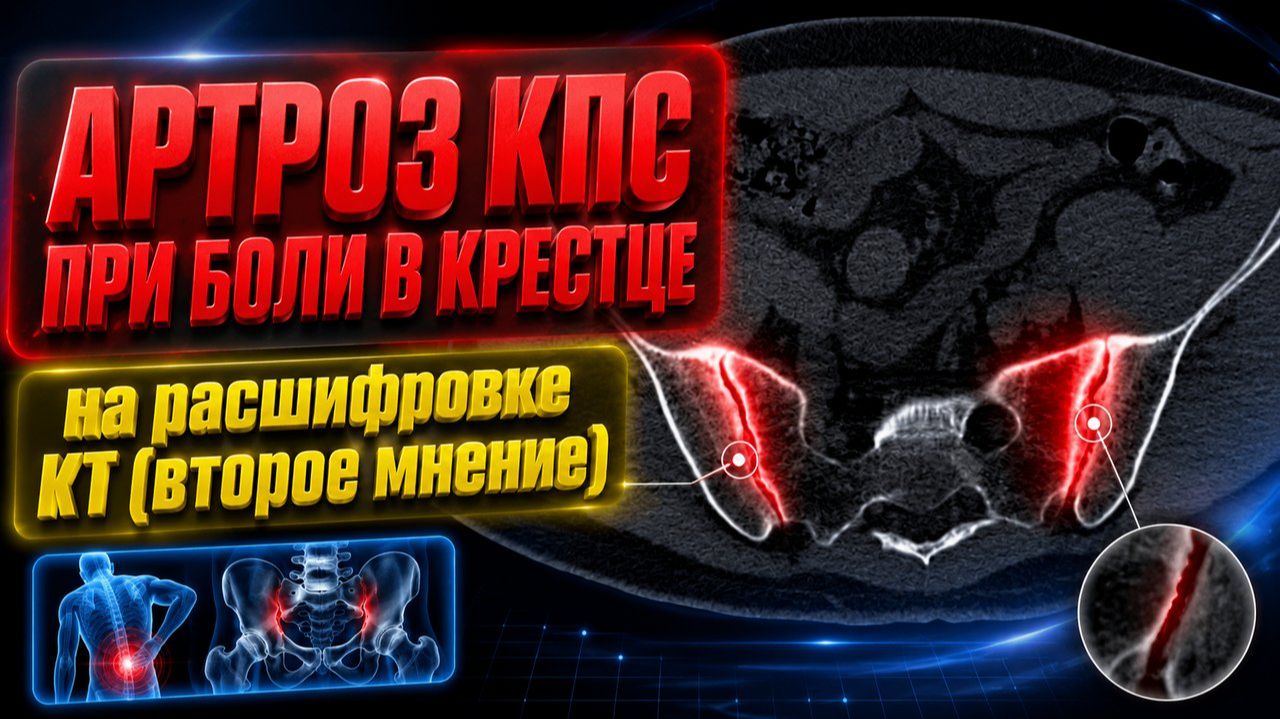 АРТРОЗ крестцово-подвздошных сочленений, БОЛИ В КРЕСТЦЕ, ягодице после САКРОИЛЕИТА на РАСШИФРОВКЕ КТ