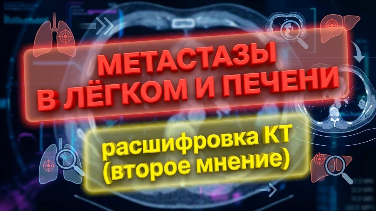 МЕТАСТАЗЫ в легких и печени, ЛИМФАДЕНОПАТИЯ средостения, АТЕРОСКЛЕРОЗ аорты на РАСШИФРОВКЕ КТ легких