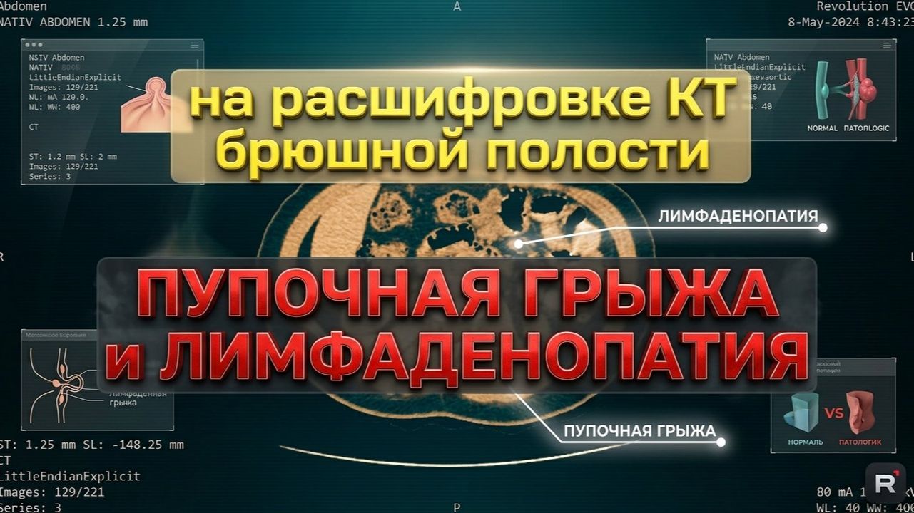 ПУПОЧНАЯ ГРЫЖА, ПЕРЕГИБ желчного пузыря и ЛИМФАДЕНОПАТИЯ на РАСШИФРОВКЕ КТ органов брюшной полости