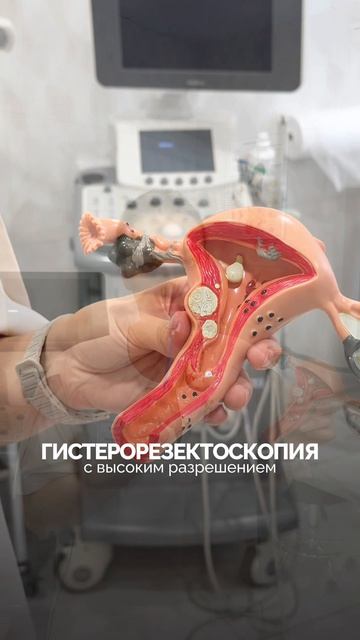 Полип эндометрия: почему его нужно удалять?
