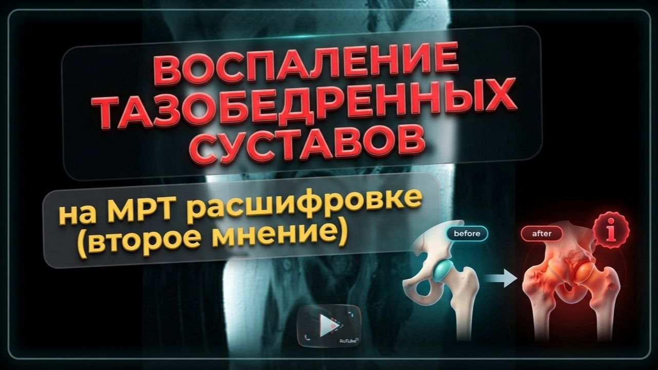 ВОСПАЛЕНИЕ тазобедренного сустава и ОСТЕОАРТРОЗ 3 степени на РАСШИФРОВКЕ МРТ тазобедренного сустава