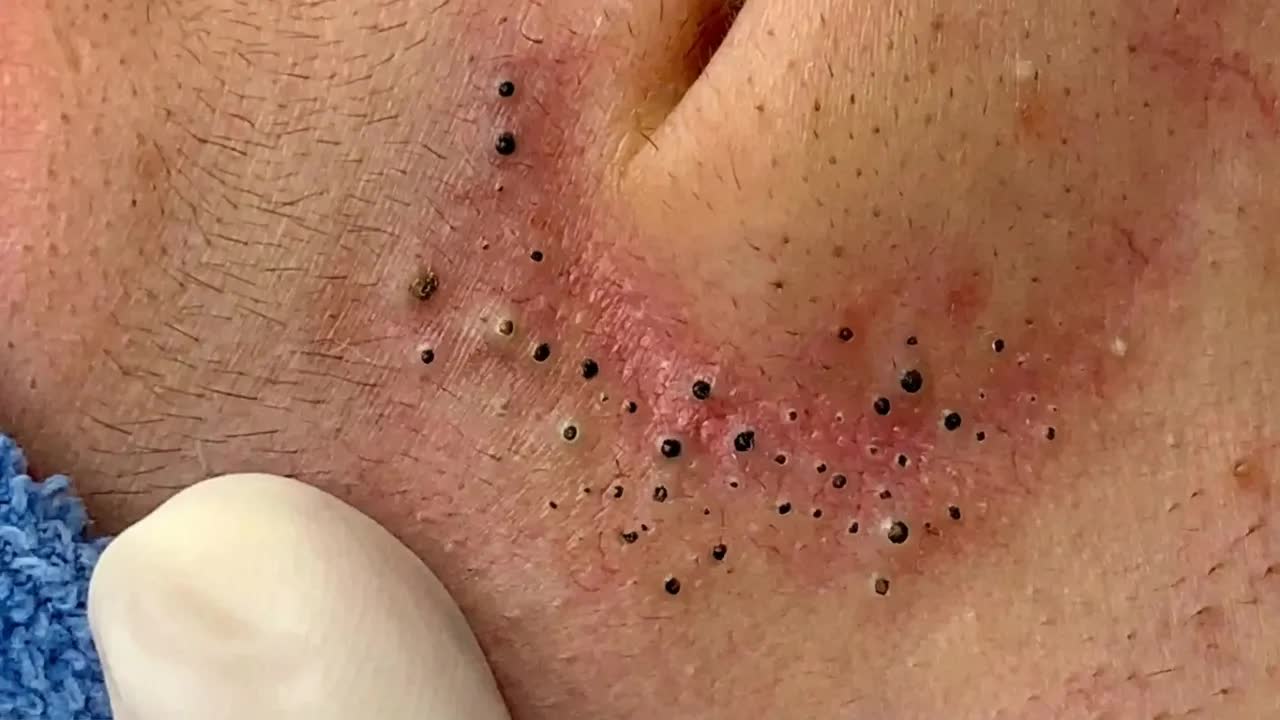 Удаление черных точек с Sac Dep Spa