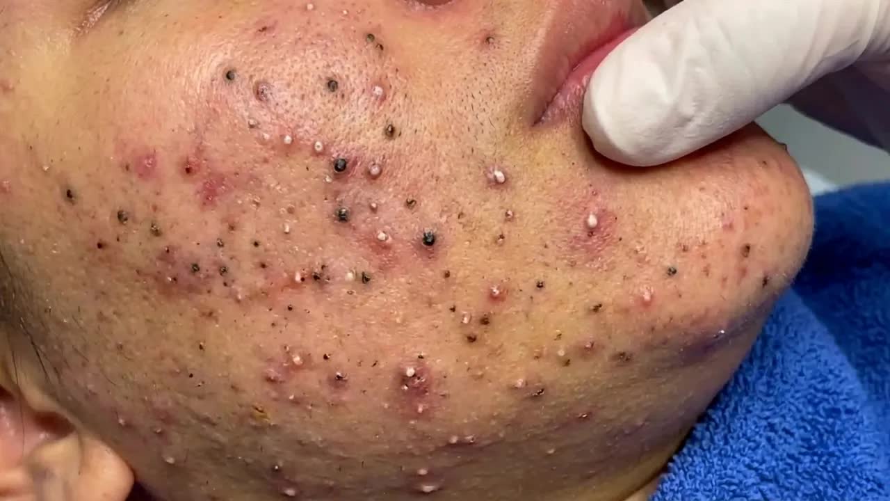 Удаление чёрных точек в спа-салоне Sac Dep