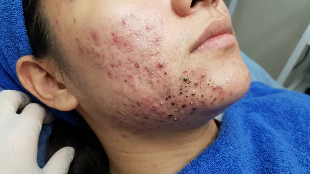 Удаление чёрных точек с Sac Dep Spa
