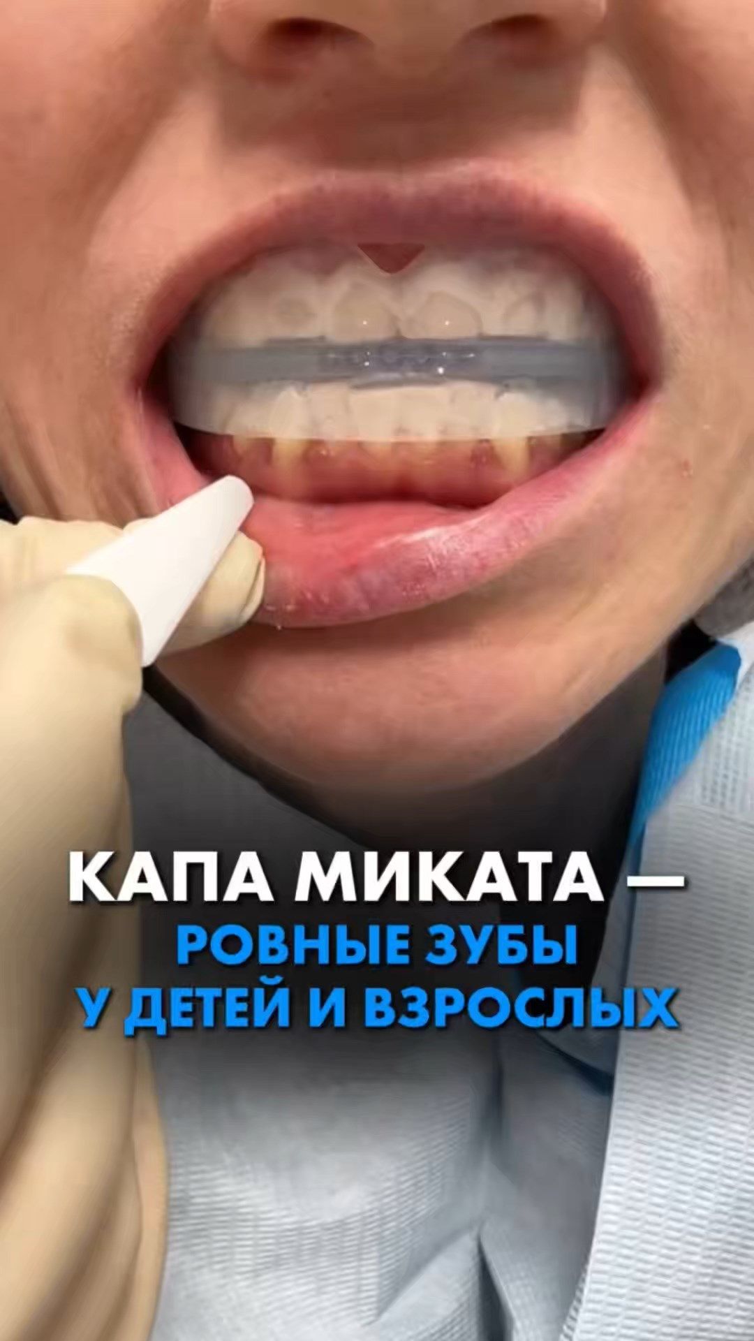 КАПА МИКАТА - РОВНЫЕ ЗУБЫ У ДЕТЕЙ И ВЗРОСЛЫХ