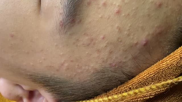 Чистка кожи – удаление прыщей и угрей