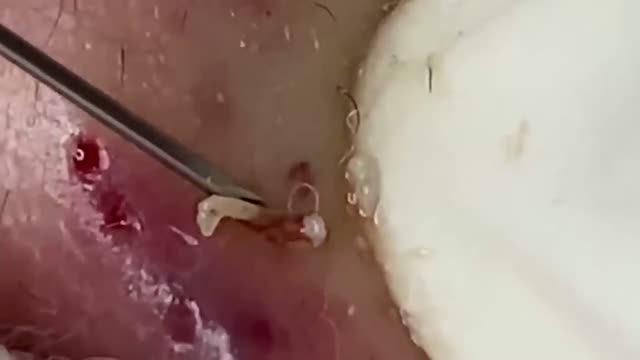 Выдавливание прыщей. слабонервным не смотреть