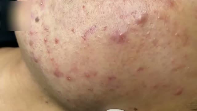 Удаление прыщей и комедонов – профессионально