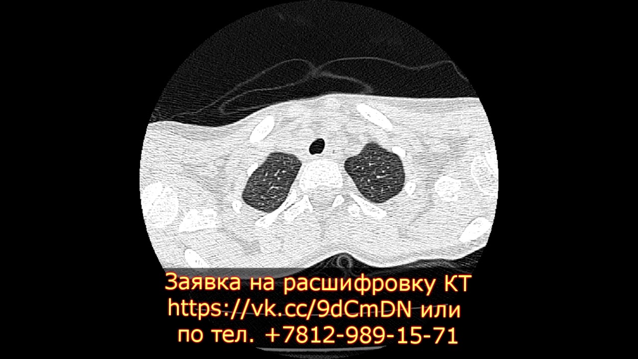 Заключение КТ легких при пересмотре диска с КТ снимками