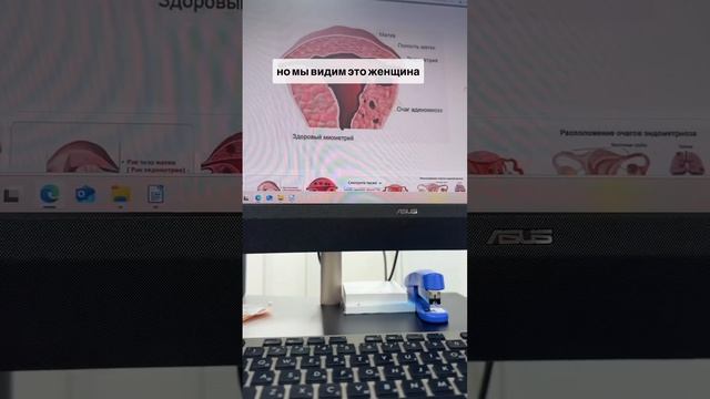Что такое аденомиоз на самом деле?