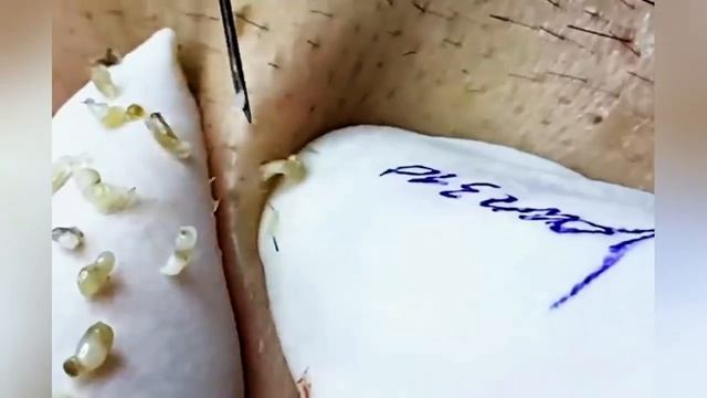 Выдавливание прыщей, угрей, черных точек и камедонов #733