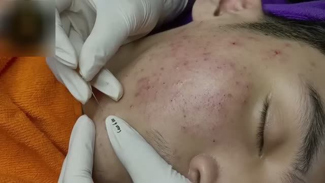 #948 Удаление акне. Экстракция комедонов. Подкожные прыщи. Чистка от черных точек
