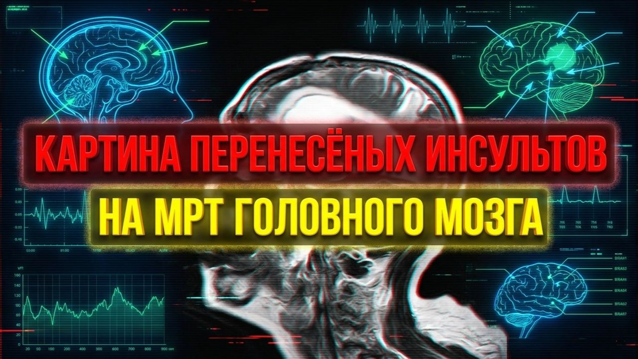 РАЗРУШЕНИЕ МОЗГА МЕТАСТАЗ в голове с ОТЕКОМ ПОСЛЕ ИНСУЛЬТОВ на МРТ головного мозга после РАСШИФРОВКИ