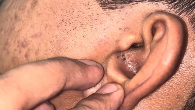 Сак-би-спа: чёрные точки у пожилых мужчин 👂| Сак-би-спа: чёрные точки на лице у мужчин 2026