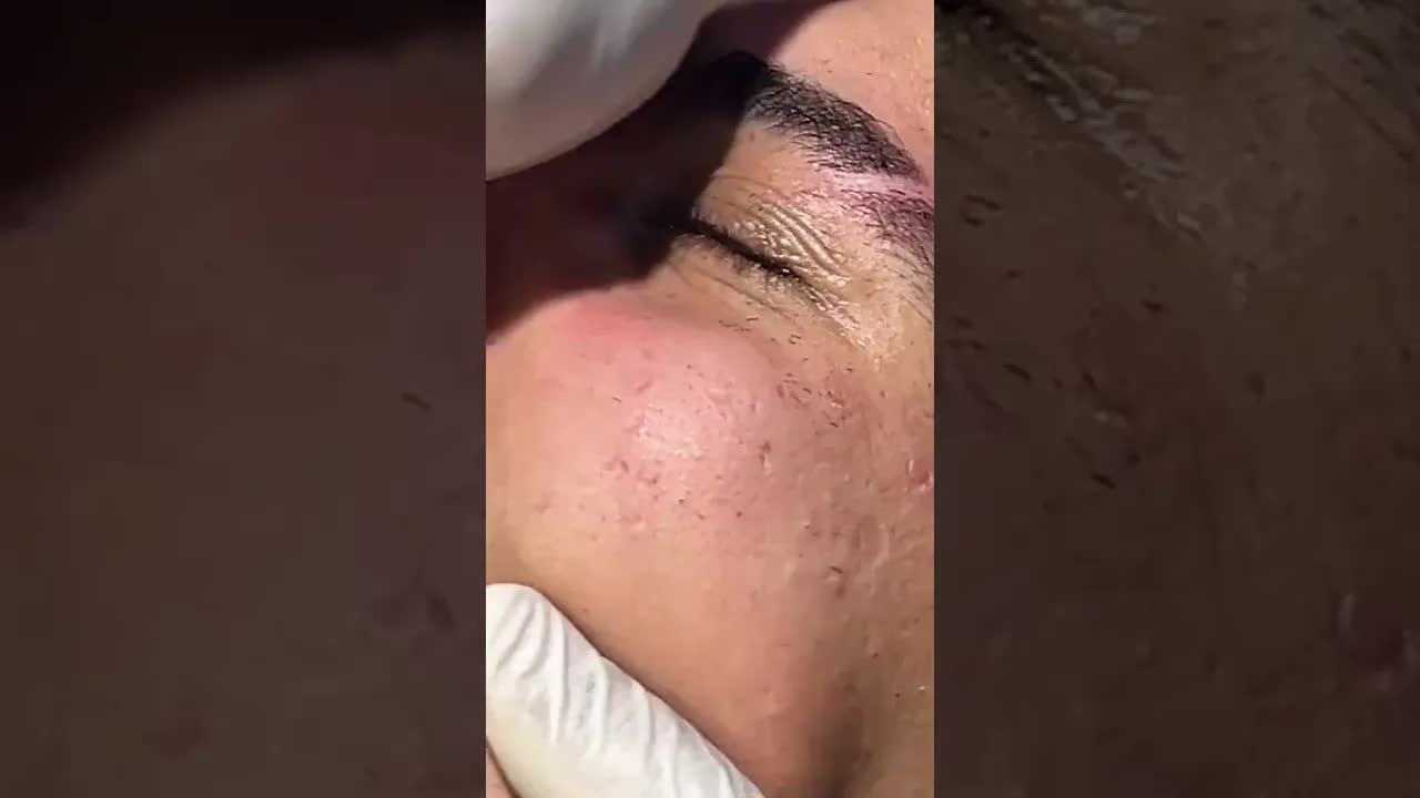 Удаление огромного черного угря на носу 🧖♀️