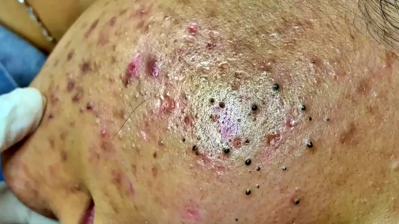 Удаление черных точек в Sак Dep Spa