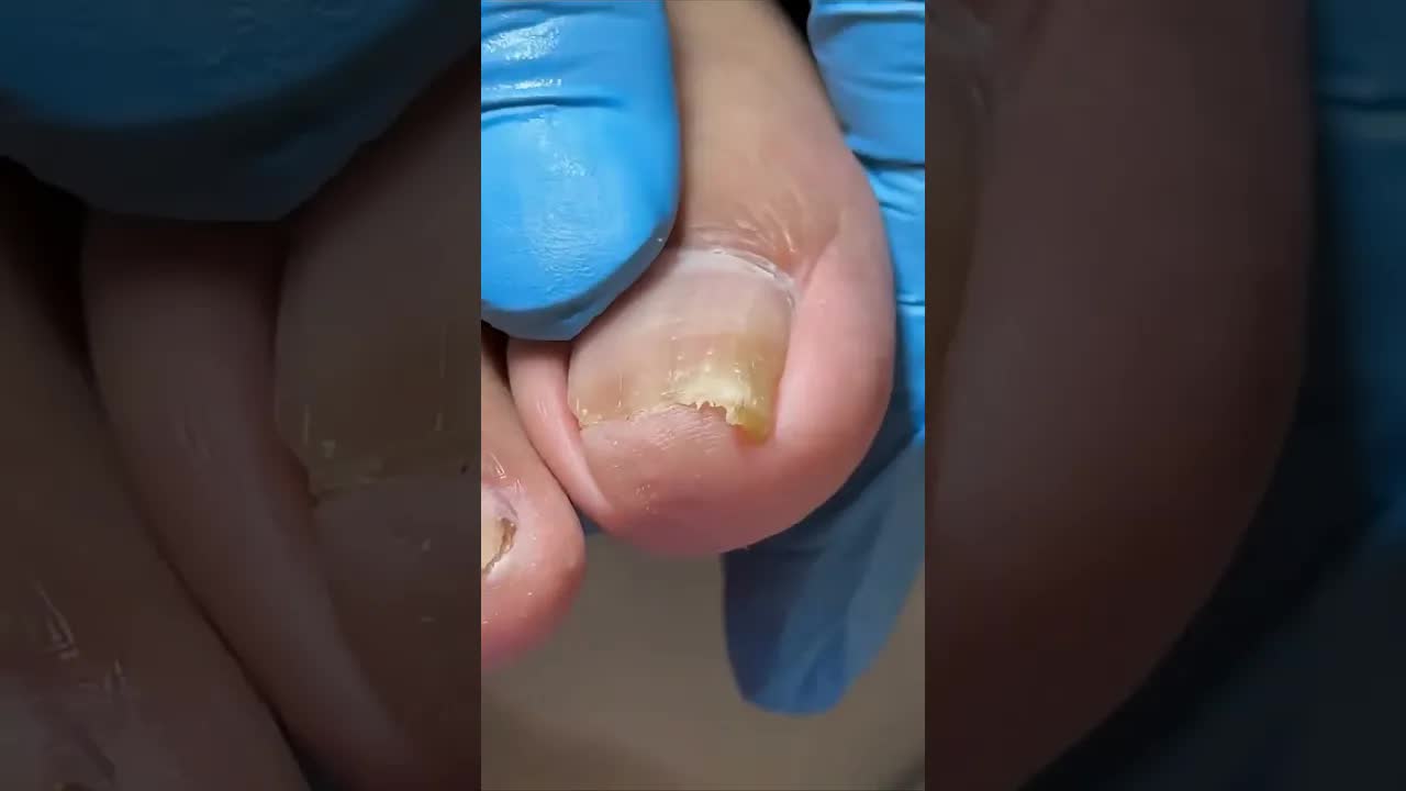 Вросшие ногти: аккуратная обработка 💅