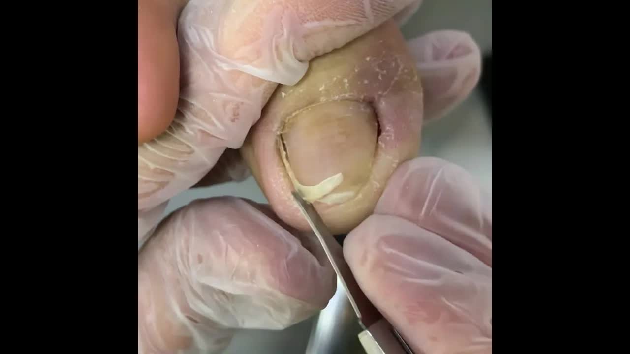 Чистка вросших ногтей и грязи. satisfying pedicure