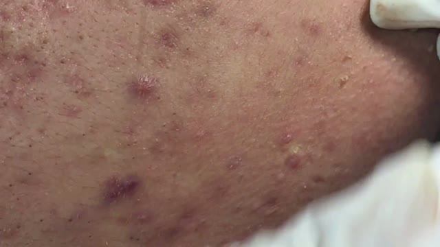 Чистка лица – удаление акне и комедонов
