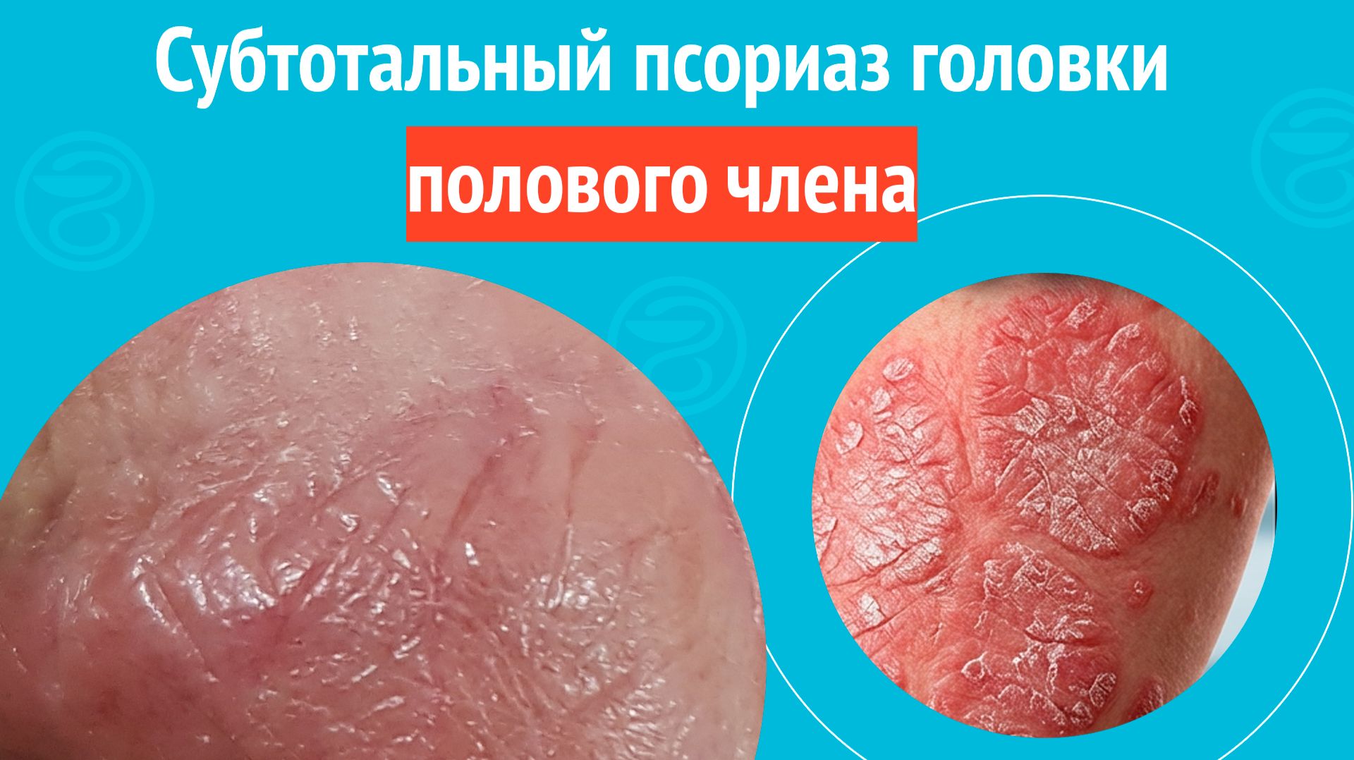 ☹️ Субтотальный псориаз головки полового члена. Клинический случай № 1837