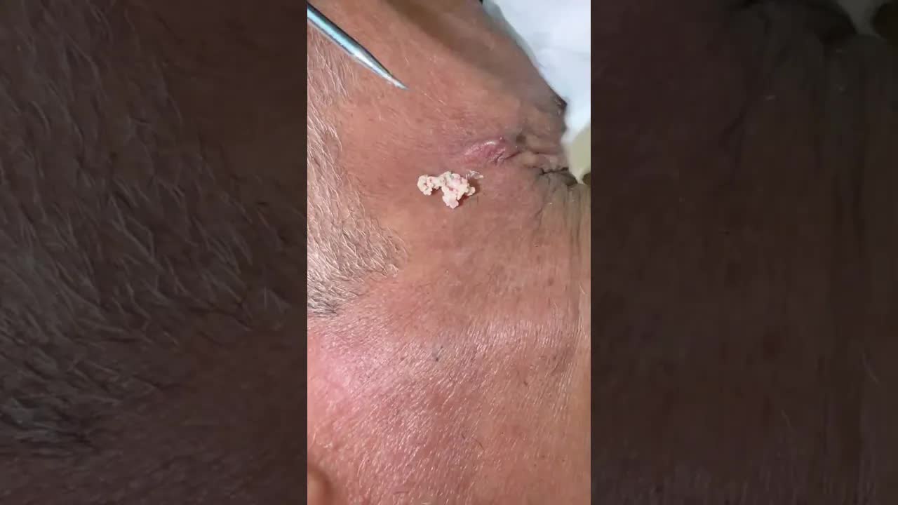 Большое удаление skincare